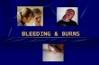 BLEEDING & BURNS. Types of external injuries Punctures.