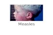 Measles. Etiology Measles virus is a spherical, nonsegmented, single- stranded, negative-sense RNA virus Morbillivirus genus in the family of Paramyxoviridae.