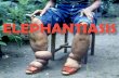 Elephantiasis is a disease that is characterized by the thickening of the skin and underlying tissues, especially in legs and male genitals.  In some.