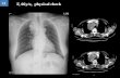 F, 66y/o, physical check 11. Ans : Intrathoracic goiter.