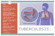 TUBERCULOSIS: INDEX: What is tuberculosis? What parts of the body are affected by tuberculosis? What is the difference between latent tuberculosis infection.