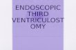 ENDOSCOPIC THIRD VENTRICULOSTOMY. Introduction – Endoscopic third ventriculostomy is a technique to treat non communicating hydrocephalus. – Involves.
