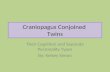 Craniopagus Conjoined Twins Their Cognition and Separate Personality Types By: Kelsey Simon.