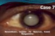 Mansukhani, Sujata To Marcial, Karmi Margarette. This 30 year old male sought consult because of blurring of vision of the left eye. Visual acuity was.