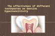 The effectivness of different toothpastes on dentine hypersensitivity.