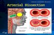 Arterial Dissection. Pitfalls (1) “I have a pain in my neck and (or) head unlike anything I have ever had before.”