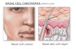 BASAL CELL CARCINOMA (RODENT ULCER) the most common skin cancer (and the most common of all cancers) a locally invasive, slowly spreading primary epithelial.
