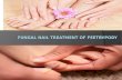 Fungal nail treatment of FeetByPody