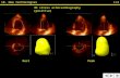 3D stress echocardiography  (positive)