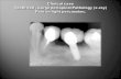 Clinical case  Tooth #20 , Large periapical Pathology (x-ray) Pain on light percussion.