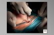 mandibolectomia e ricostruzione con innesto vascolarivato da perone