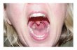 How To Stop Tonsil Stones