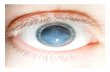 Natural remedies for floaters in the eye