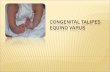 131950465 Congenital Talipes Equino Varus Asli
