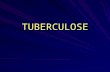 TUBERCULOSE. TUBERCULOSE - Diagnóstico Doença Pulmonar Ativa –Pesquisa bacteriológica É método prioritário Permite identificar o paciente bacilífero (principal.