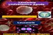 leucemia linfoblastica aguda 3D.pptx