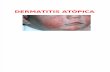 Dermatitis Atópica y Seborreica
