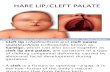 Cleft Lip Palate[1]
