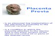 Placenta Previa (no animation)