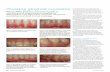 Treating gingival recession