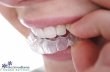All about INVISALIGN