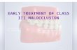 early treatment of class III malocclusion
