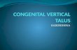 Congenital vertical talus
