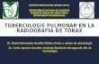 Tuberculosis pulmonar en la radiografía de tórax