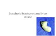 Scaphoid fractures and non union