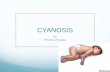 Cyanosis in newborn