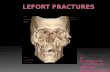 Lefort fractures