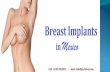 Breast Implants in Mexico