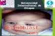 Retinoblastoma Universidad Intercultural de Chiapas