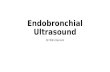 Endobronchial ultrasound - EBUS
