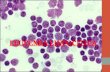 Leucemia linfocitica