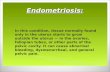 Endometriosis:  In this condition, tissue normally found only in the uterus starts to grow outside the uterus — in the ovaries, fallopian tubes, or other.