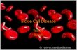 Sickle Cell Disease Taeron Burrell. What Is Sickle Cell Anemia? Sickle cell Anemia is a serious disorder in which the body makes sickle shape blood cells.