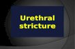 Urethral stricture. *May be congenital or acquired. *Acquired urethral sricture is common in men but rare in women. Aetiology 1. congenital 2. Traumatic.