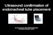 Ultrasound confirmation of endotracheal tube placement