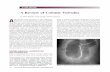 A Review of Colonic Volvulus - · PDF fileA Review of Colonic Volvulus A ... sigmoid colon with a maximal diameter of 14 cm sug-gestive of a sigmoid volvulus (Figure 1). Urgent flexible