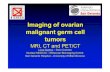 Imaging of ovarian malignant germ cell tumors - SICHIG of ovarian malignant germ cell tumors MRI, CT and PET/CT ... round or irregular ... N staging in ovarian germ cell tumor