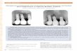 Management of Retrograde Peri-Implantitis by Apical ...€¦ · Management of Retrograde Peri-Implantitis by Apical Resection and Guided Bone Regeneration in Adjacent Maxillary Implants