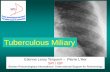 Tuberculous Miliary - ISR Radiology TB Miliary.pdf · Diagnosis of miliary: • Requires a good quality chest radiograph • and careful analysis: NEGATOSCOPE! • The images are