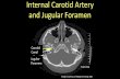 Internal Carotid Artery and Jugular Foramencases.med.wisc.edu/anatomy/dissections/radiologyimages/Radiology... · Internal Carotid Artery and Jugular Foramen Carotid ... Anatomy at