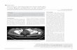 CASE STUDY Vasal Injury During Inguinal Herniorrhaphy: A ... · CASE STUDY Vasal Injury During Inguinal Herniorrhaphy: A ...