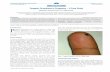 CASE REPORT Pyogenic Granuloma in Pregnancy - A …medicaljournal.in/.../Pyogenic-Granuloma-Pregnancy.pdf · Academic edica ourna of India 43 olume - ssue 1 Pyogenic Granuloma in