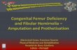 Congenital Femur Deficiency and Fibular Hemimelia ...repositorio.chlc.min-saude.pt/bitstream/10400.17/974/1/ap_63.pdf · Congenital Femur Deficiency and Fibular Hemimelia – Amputation