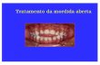 Tratamento da mordida aberta - moroortodontia.com.brmoroortodontia.com.br/aulaspg/mordida aberta.pdf · n Altura dentoalveolar aumentada Alterações na mandíbula ... mordida profunda.