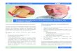 35 Próstata (HBP) - patients.uroweb.org · Informação para Doentes - Hiperplasia Benigna da Próstata (HBP) Página 6 / 15 Tratamento a Laser Os tratamentos com laser são uma