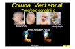 coluna vertebral 2008 - Dr. Sizinio Kanan Hebert · Deformidades na coluna vertebral e bacia Escol. na Neurofibromatose Manchas café com leite. Limitação da flexão, dor, rigidez